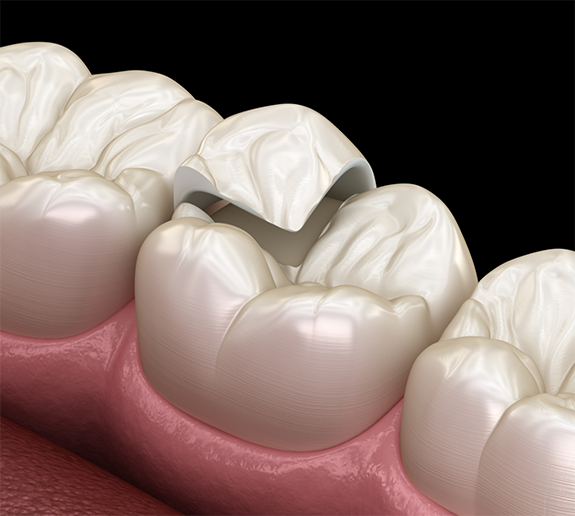 Illustration of a metal-free restoration being attached to a tooth