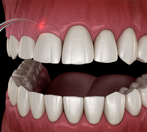 Illustration of gum recontouring performed with a laser