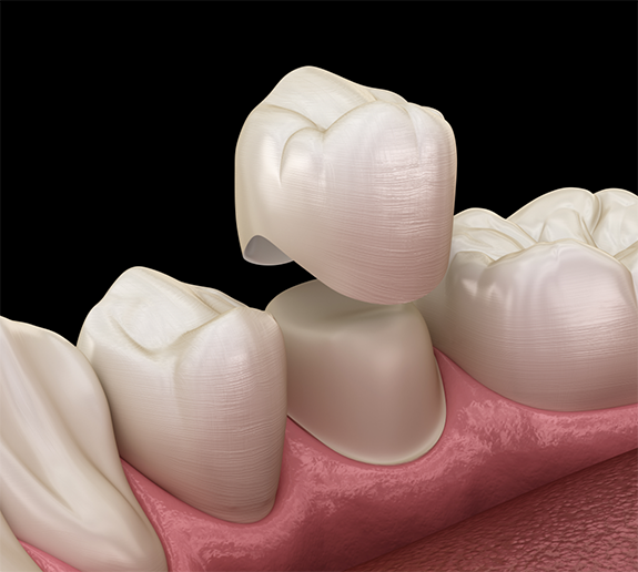 Illustration of dental crown in Little Rock being attached to a dental crown