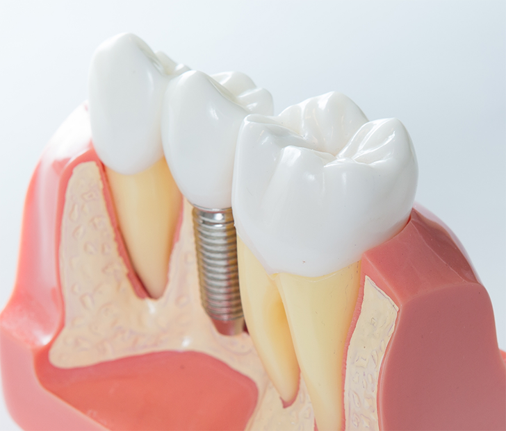 Close up of model of dental implant in Little Rock