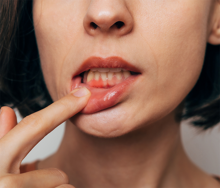 Woman pulling down lip and showing symptoms of gum disease