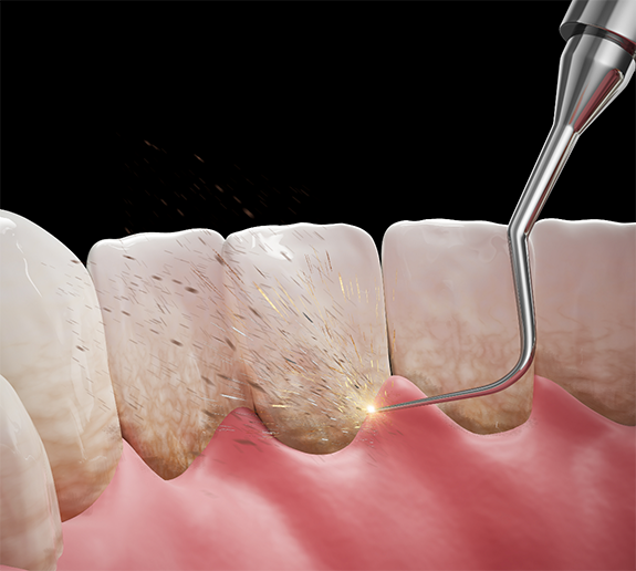 Illustration of scaling and root planing for back of teeth