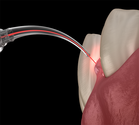 Illustration of laser being used to treat gums
