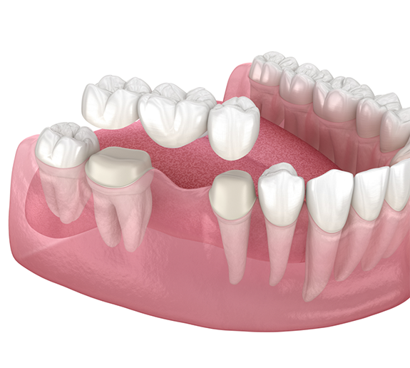 Illustration of dental bridge being attached to teeth in lower arch