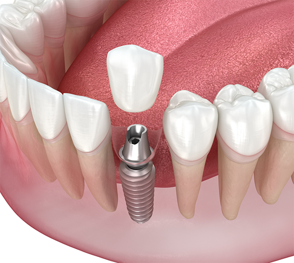 Illustration of crown being attached to a single dental implant