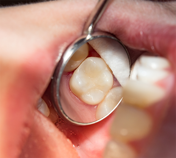 Using dental mirror to examine a tooth