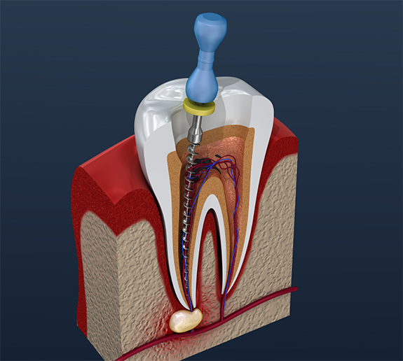 Illustration of root canal treatment