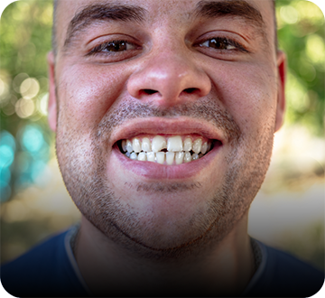 Smiling man showing a chipped tooth